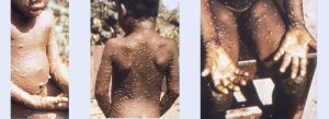 monkeypox homepage images 3